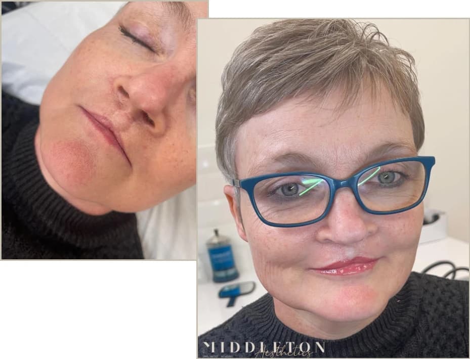 Cleft Lip Tattooing Result